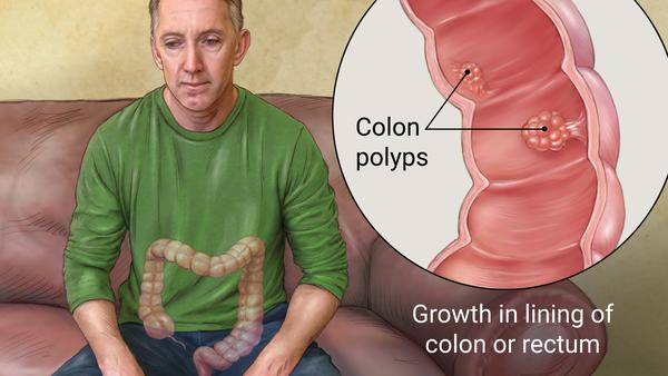 Preventing Colon Polyps Kansas Surgical Consultants   Download 