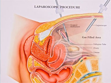 laparoscopy procedures
